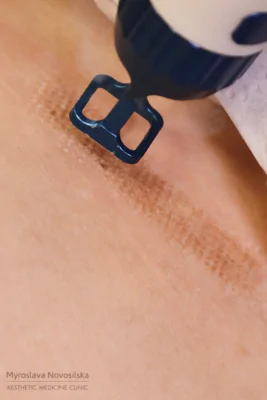 Лазерне шліфування обличчя