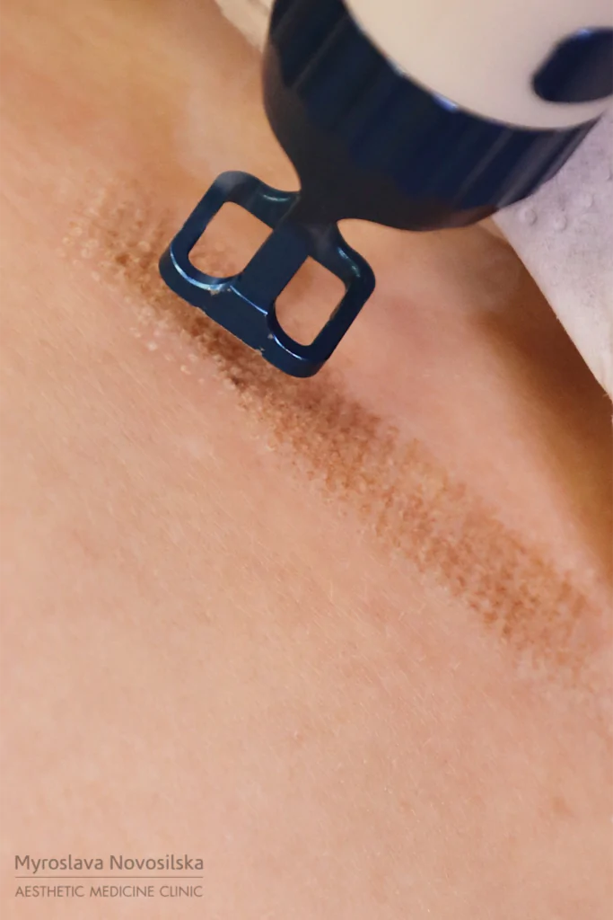 Лазерне шліфування обличчя