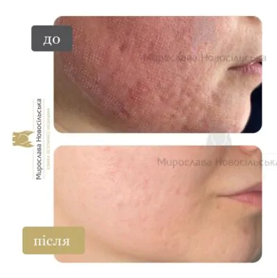 лазерне шліфування шкіри