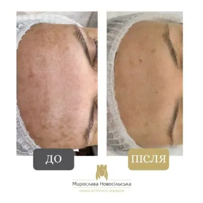 Laser removal of pigmentation 