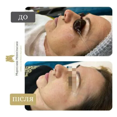 Laser removal of pigmentation on the face