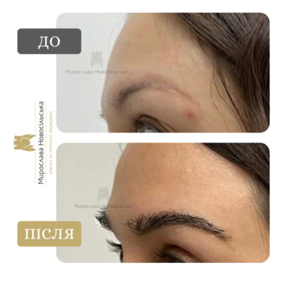 пересадка брів