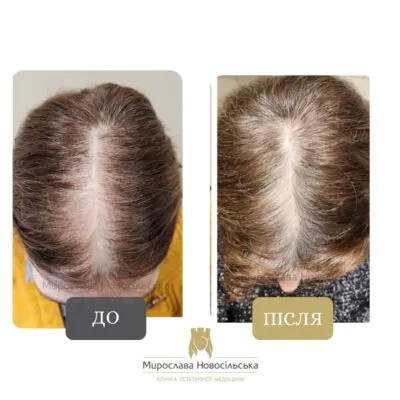 лікування випадіння волосся фото до після