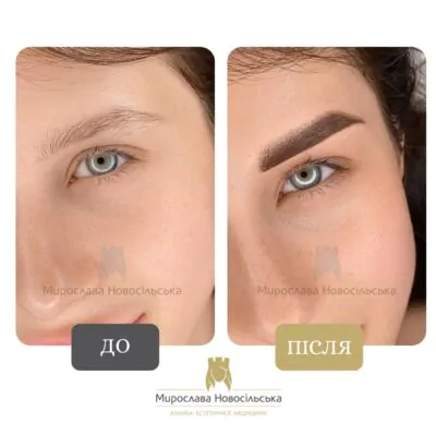 пересадка брів