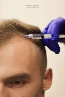 мезотерапія волосся