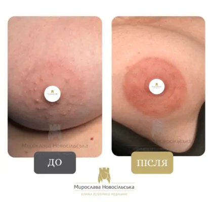 перманентний макіяж сосків як виглядає фото