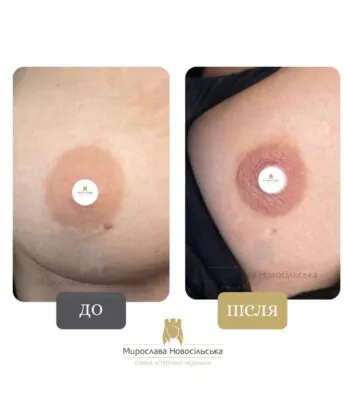 татуаж ареол грудей у Львові