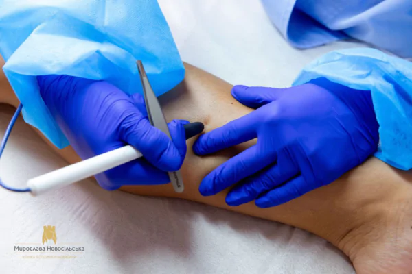 Електроепіляція