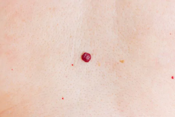 What Is a Hemangioma