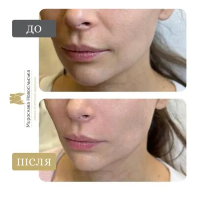 Nasolabial Fold Correction