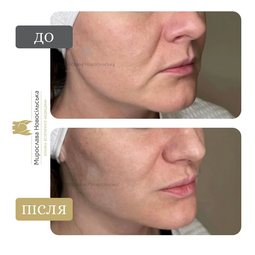 Correction of nasolabial folds