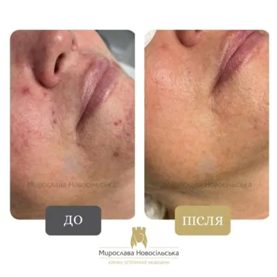 before and after facial couperose treatment