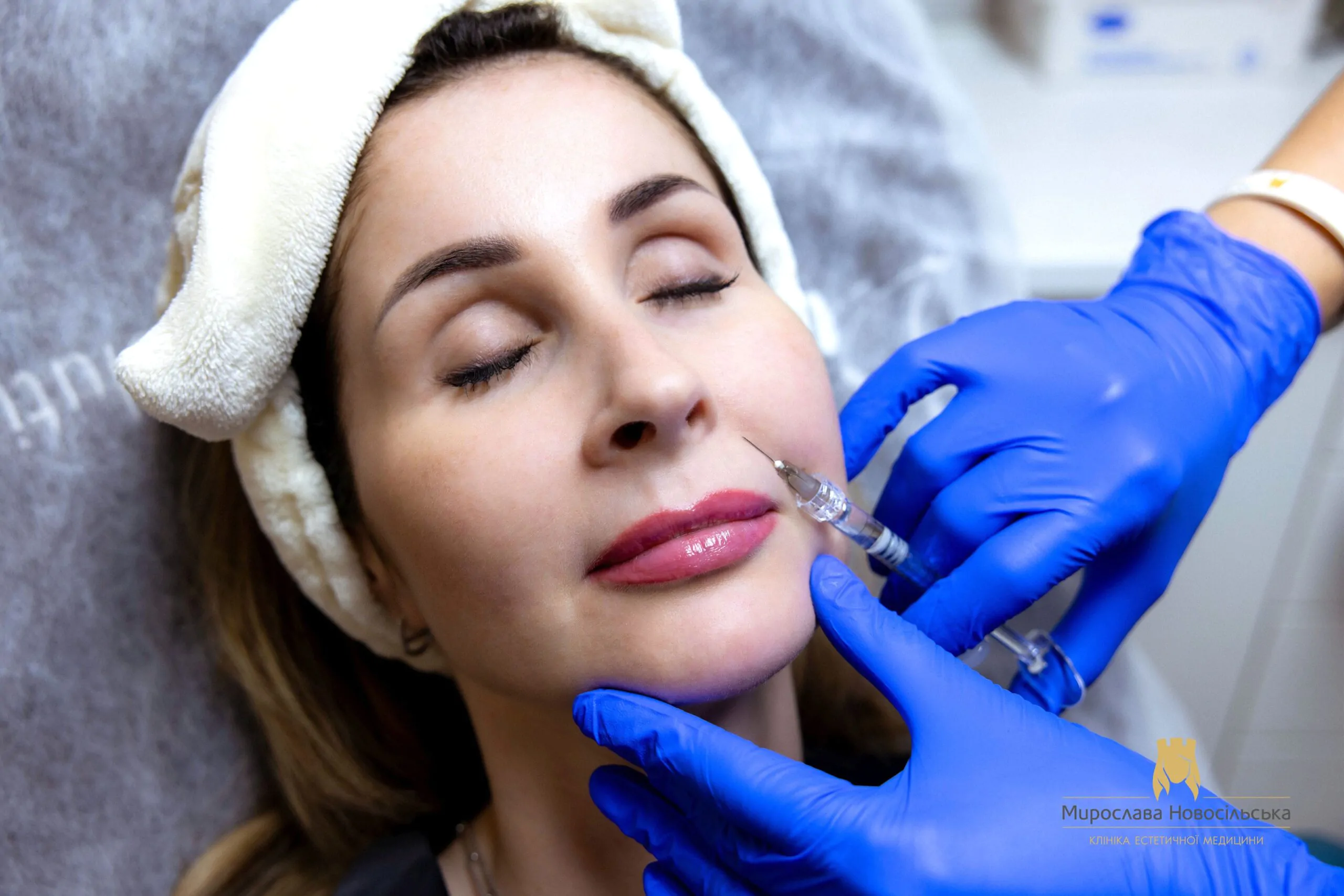 Correction of nasolabial folds