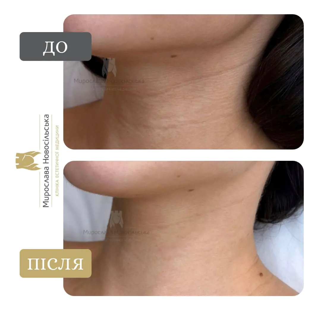 Biorevitalization of the neck and decollete zone