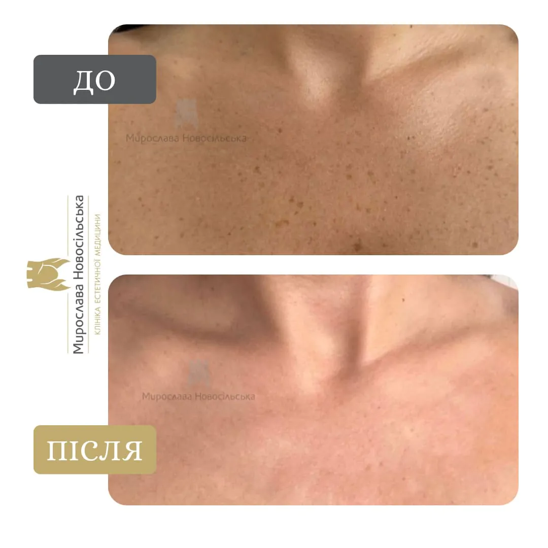 Photorejuvenation