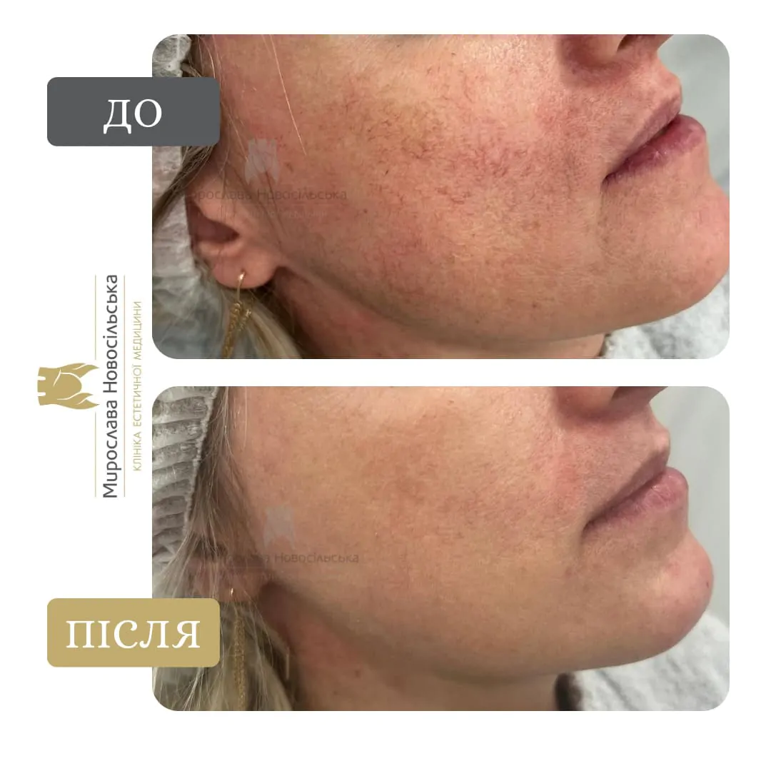 Photorejuvenation