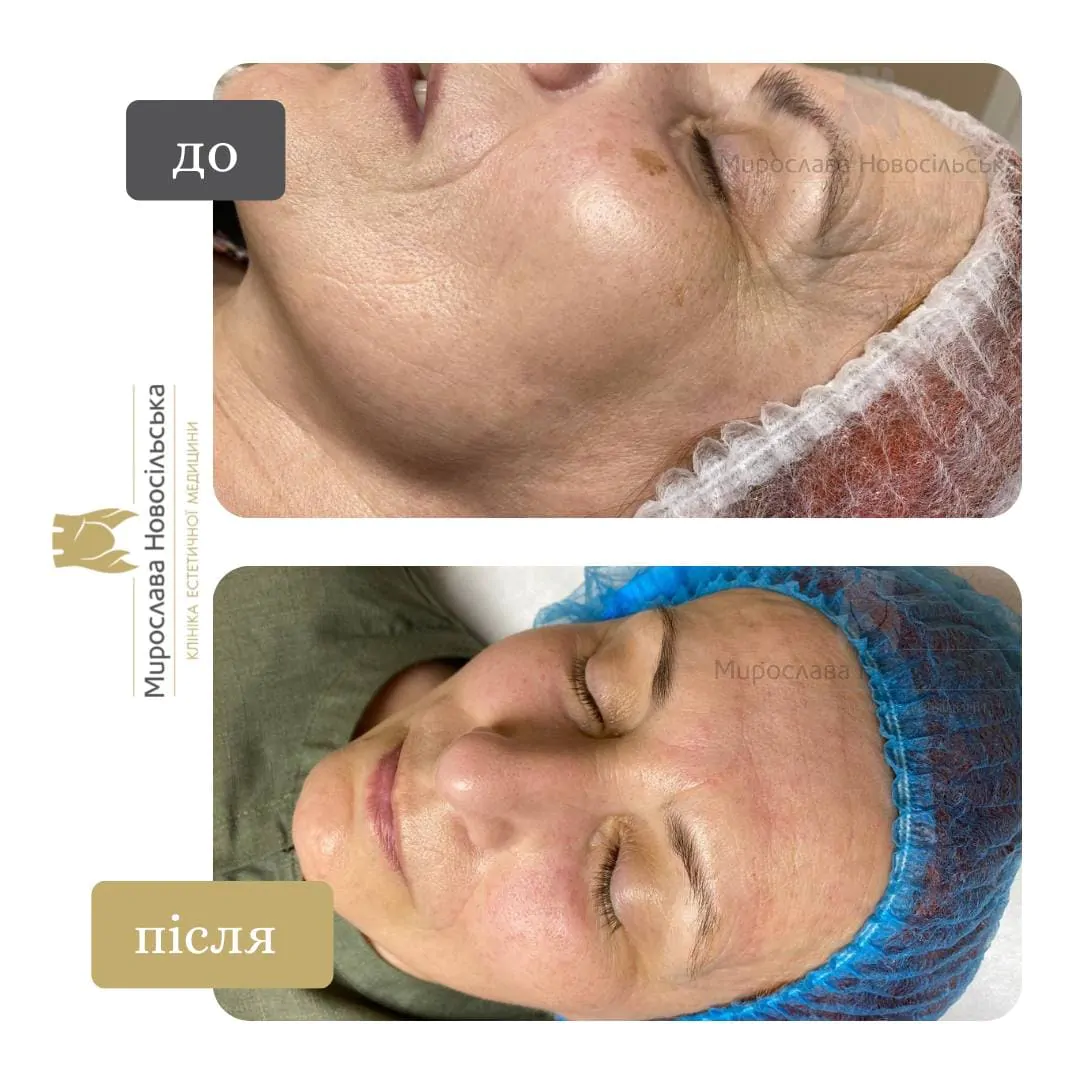 Photorejuvenation