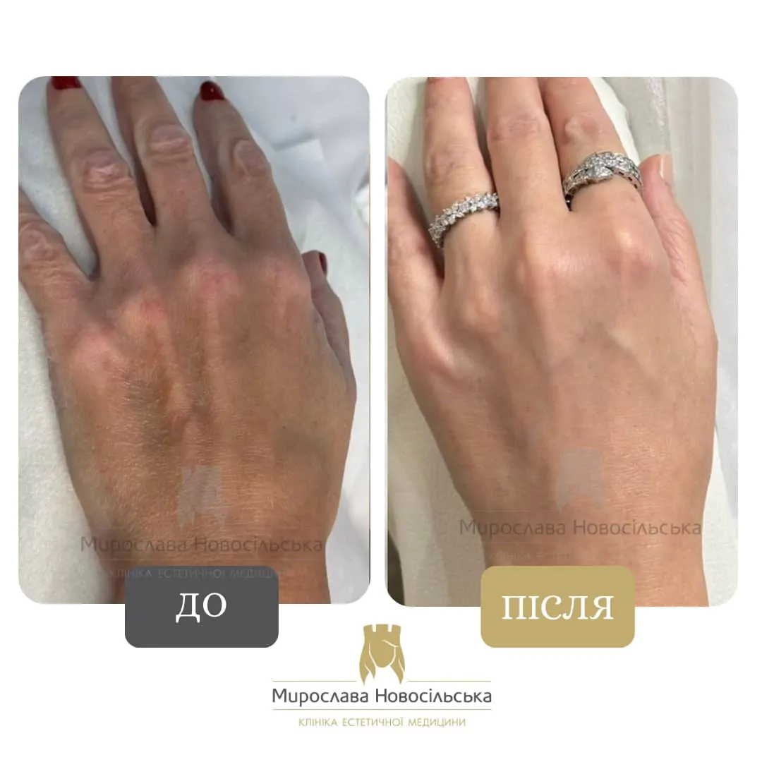Photorejuvenation