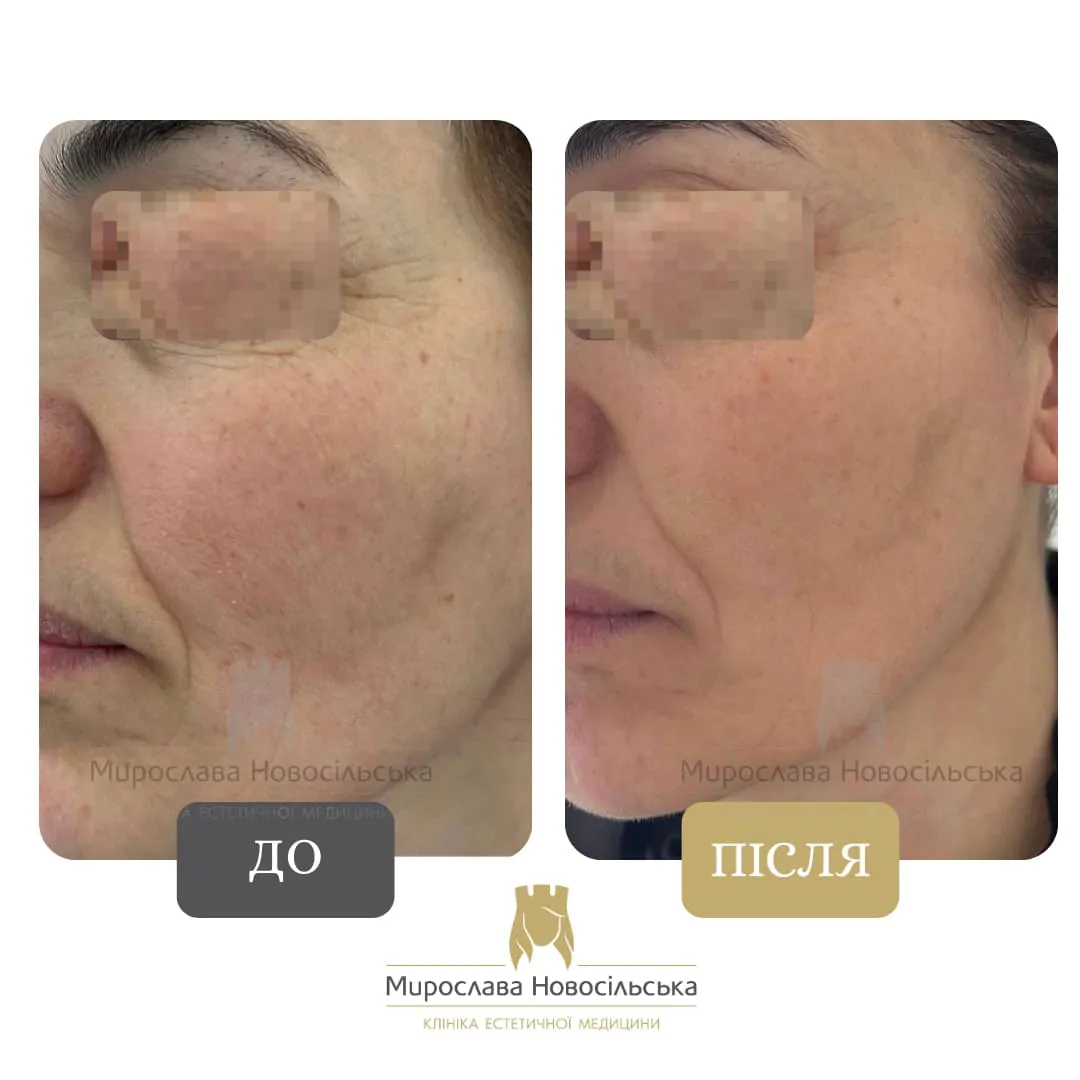 Photorejuvenation