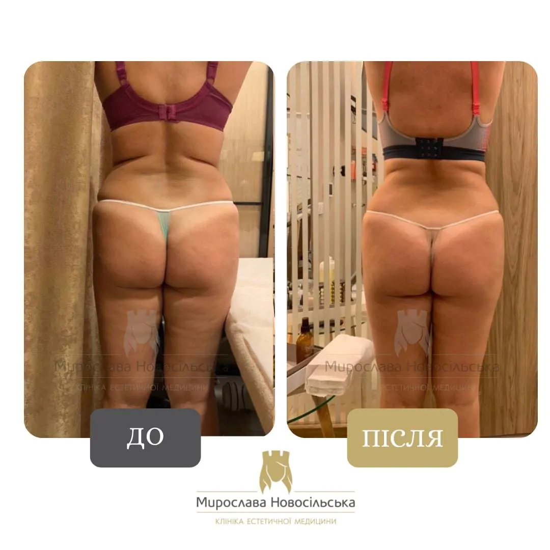 Anti-Cellulite Massage in Lviv