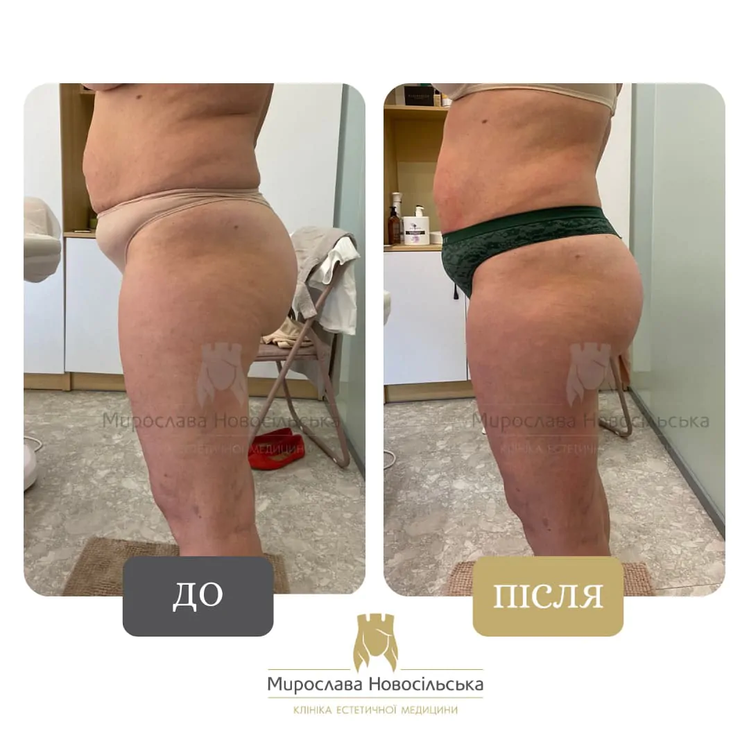 Anti-Cellulite Massage in Lviv