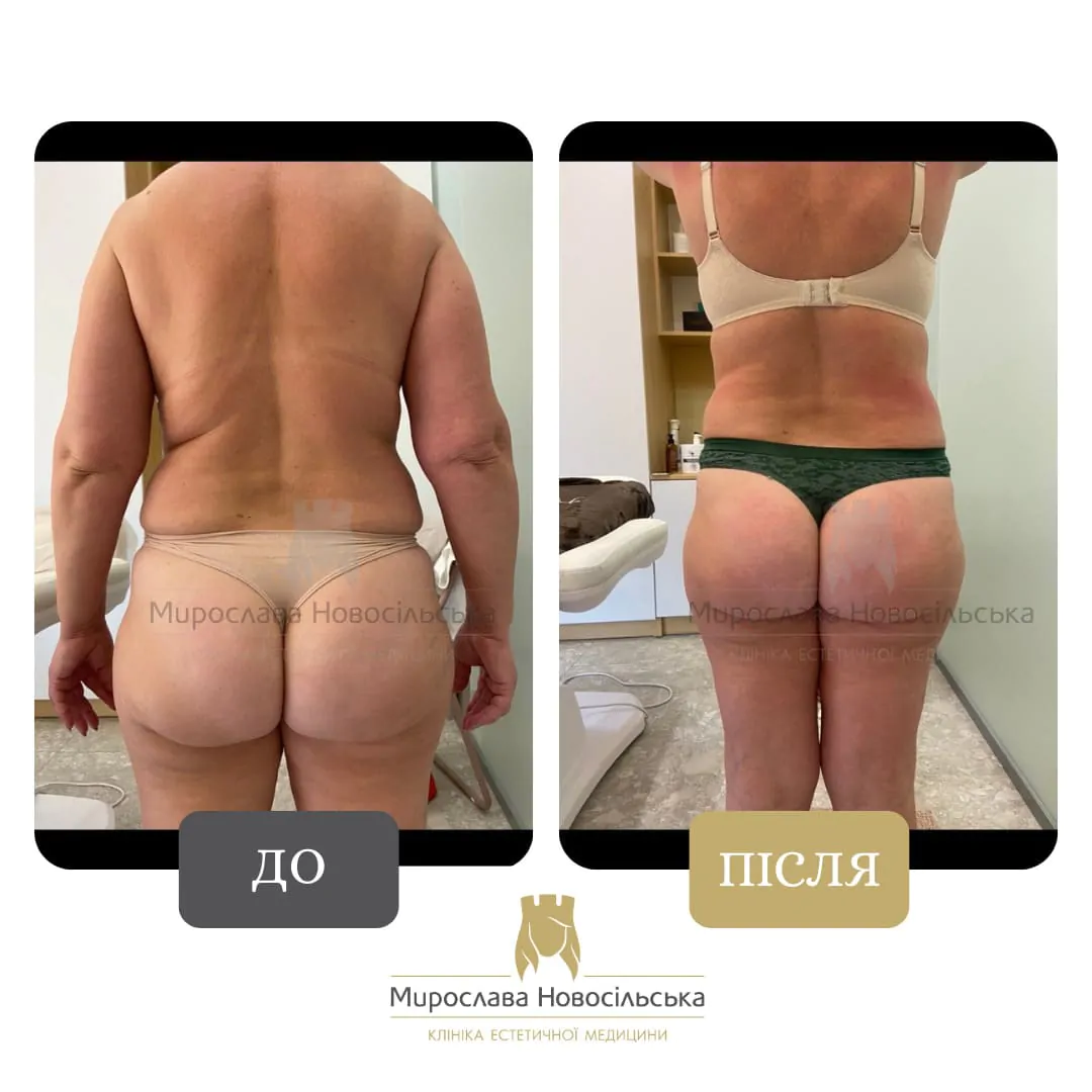 Anti-Cellulite Massage in Lviv