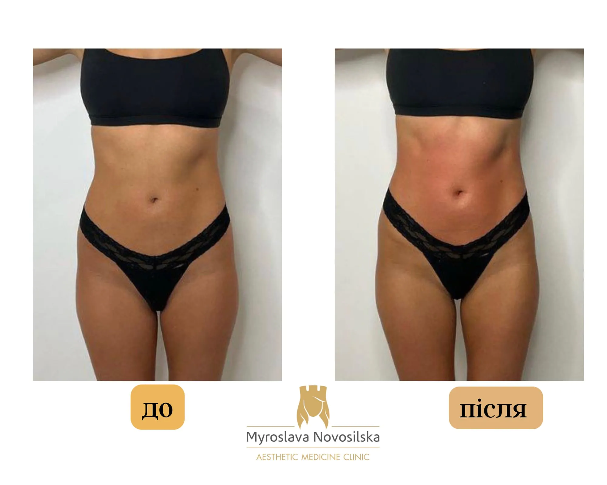 Anti-Cellulite Massage in Lviv