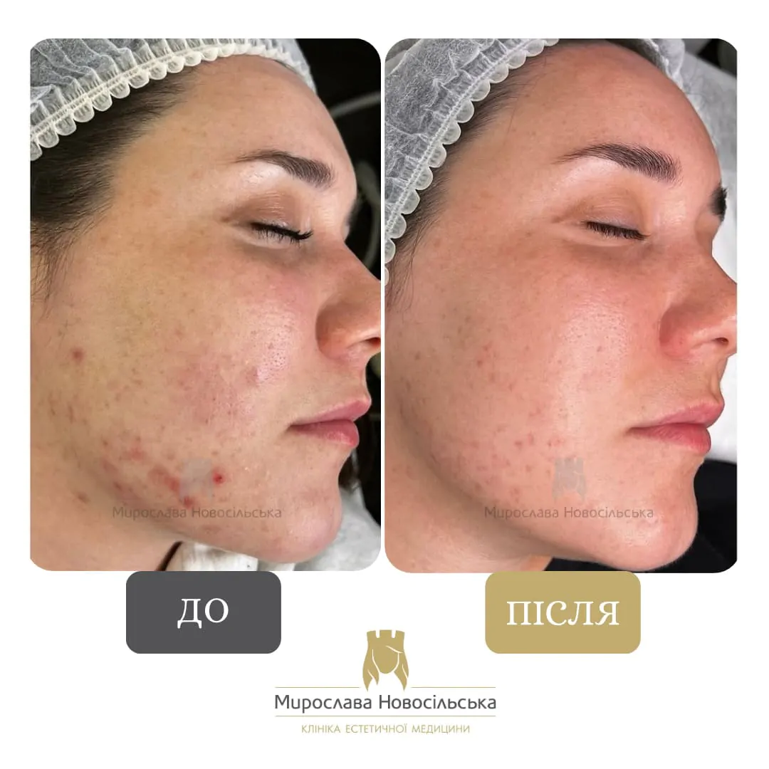 Facial mesotherapy
