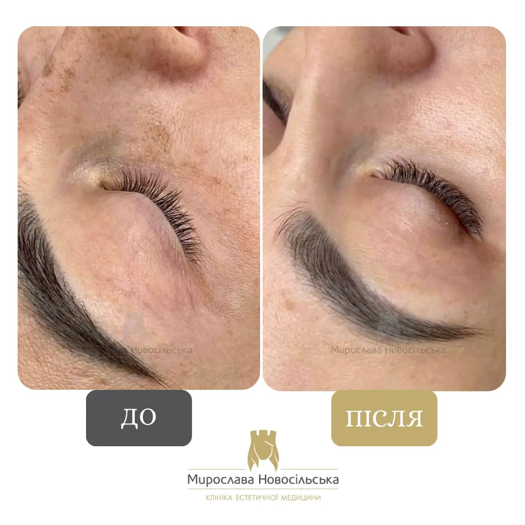 Facial mesotherapy