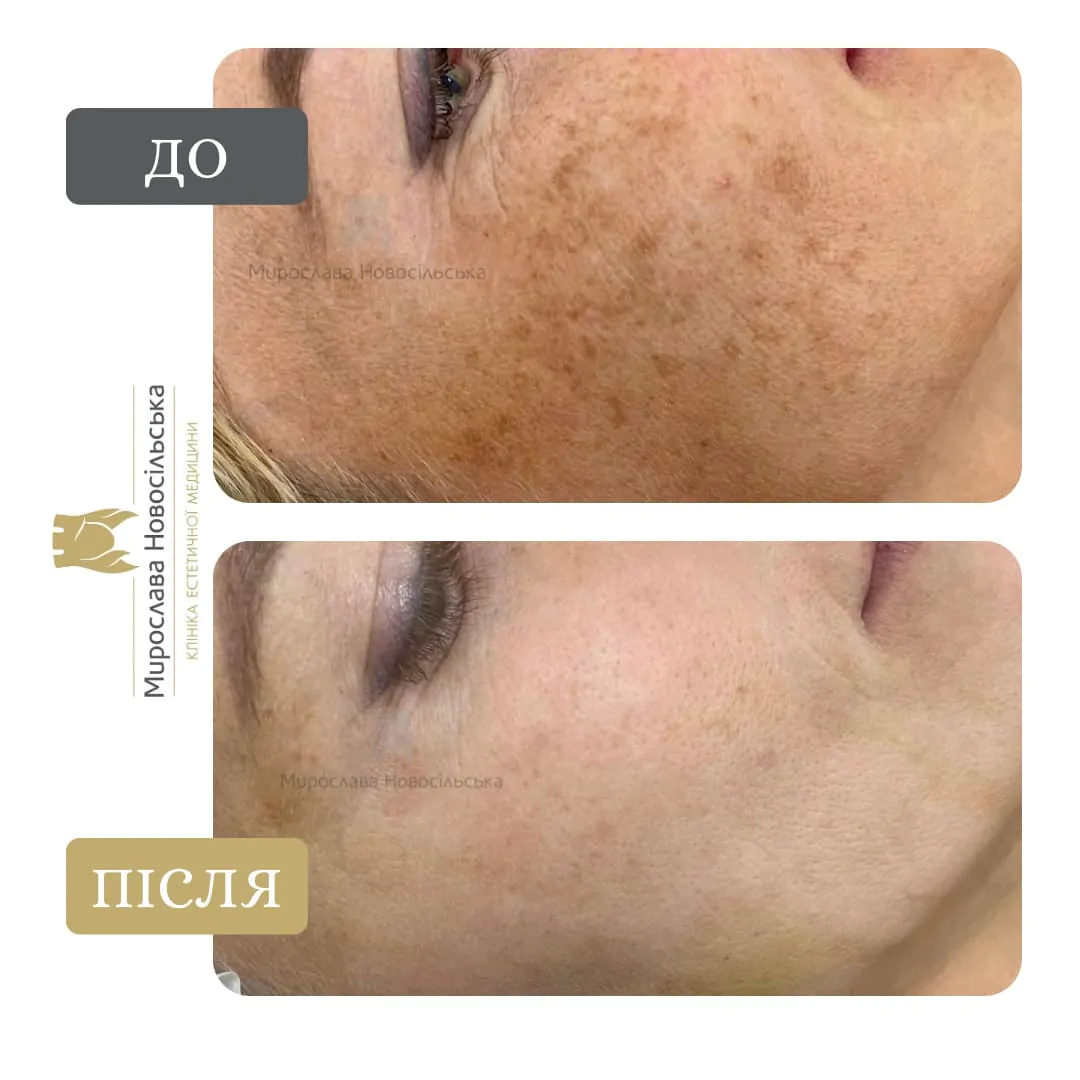 Facial mesotherapy