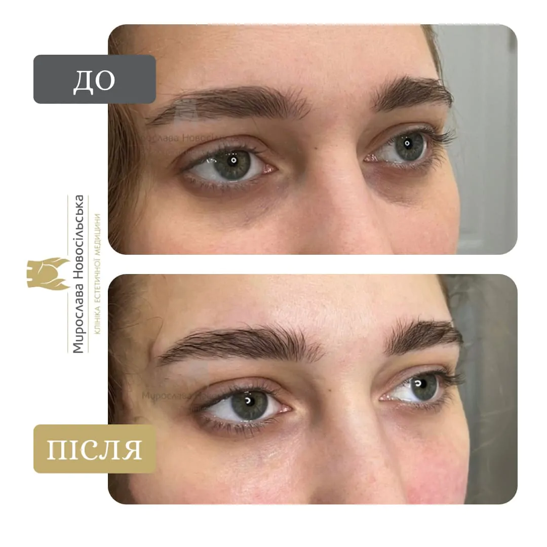 Eye mesotherapy Eye mesotherapy
