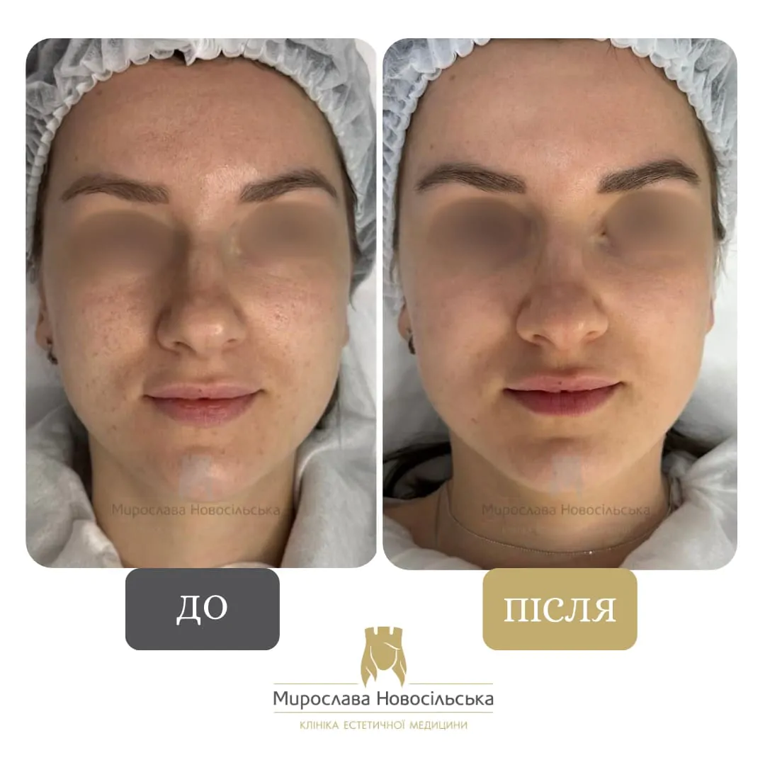 Facial mesotherapy