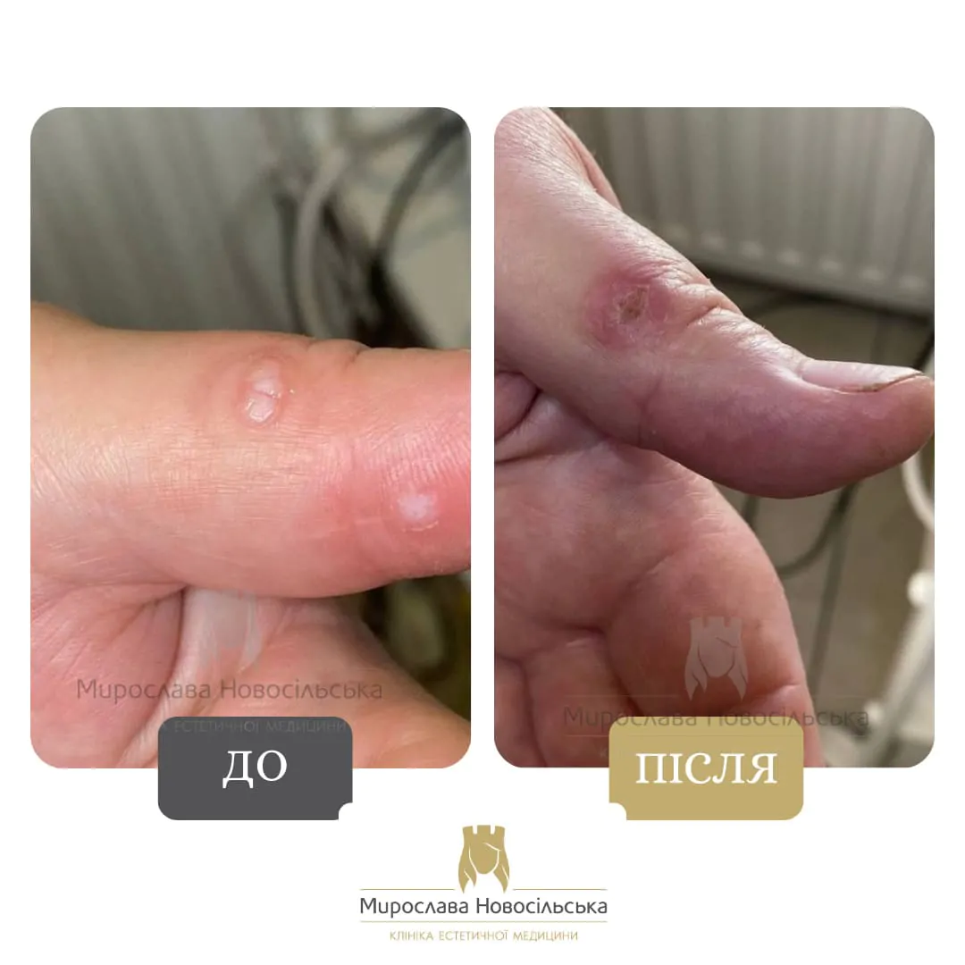 Removal of warts on hands