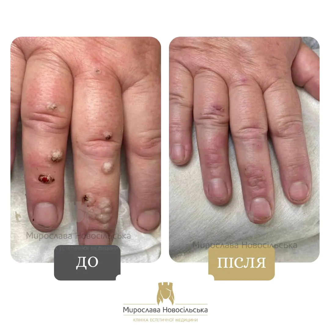 Removal of warts on hands