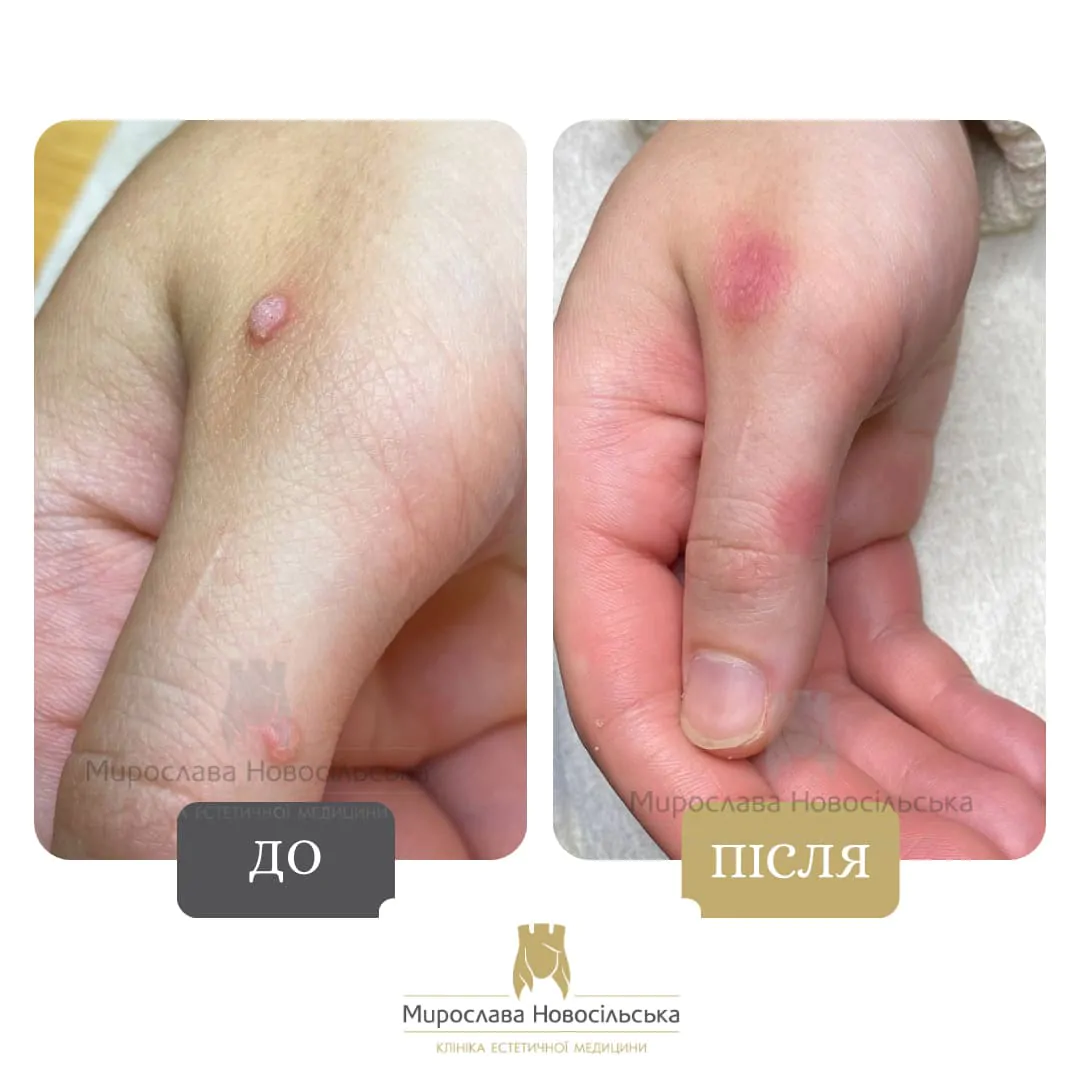 Removal of warts on hands