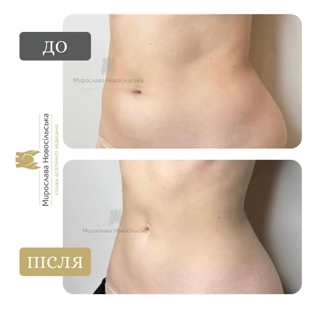 Injection lipolysis Injection lipolysis