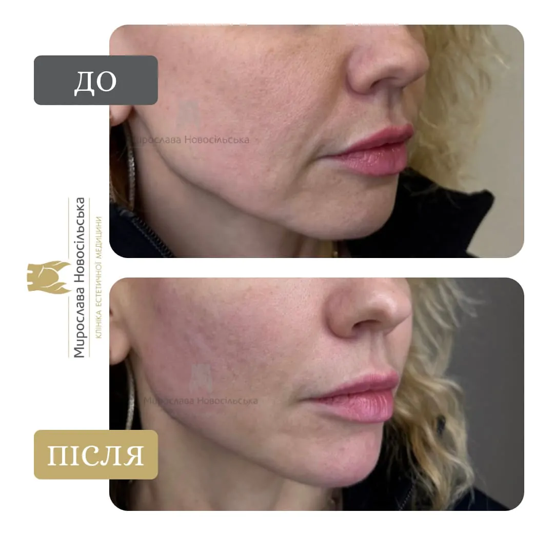 Injections of polylactic acid