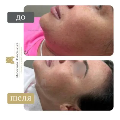 lipolytics against the second chin